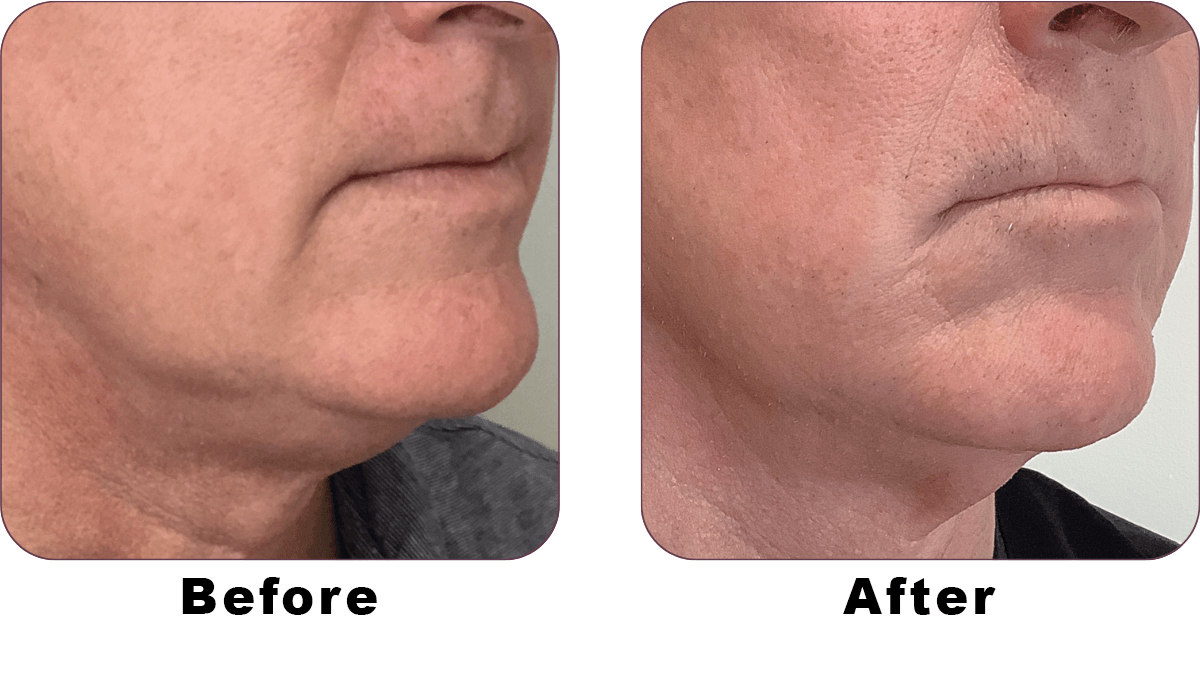 SOFWAVE BEFORE AND AFTER